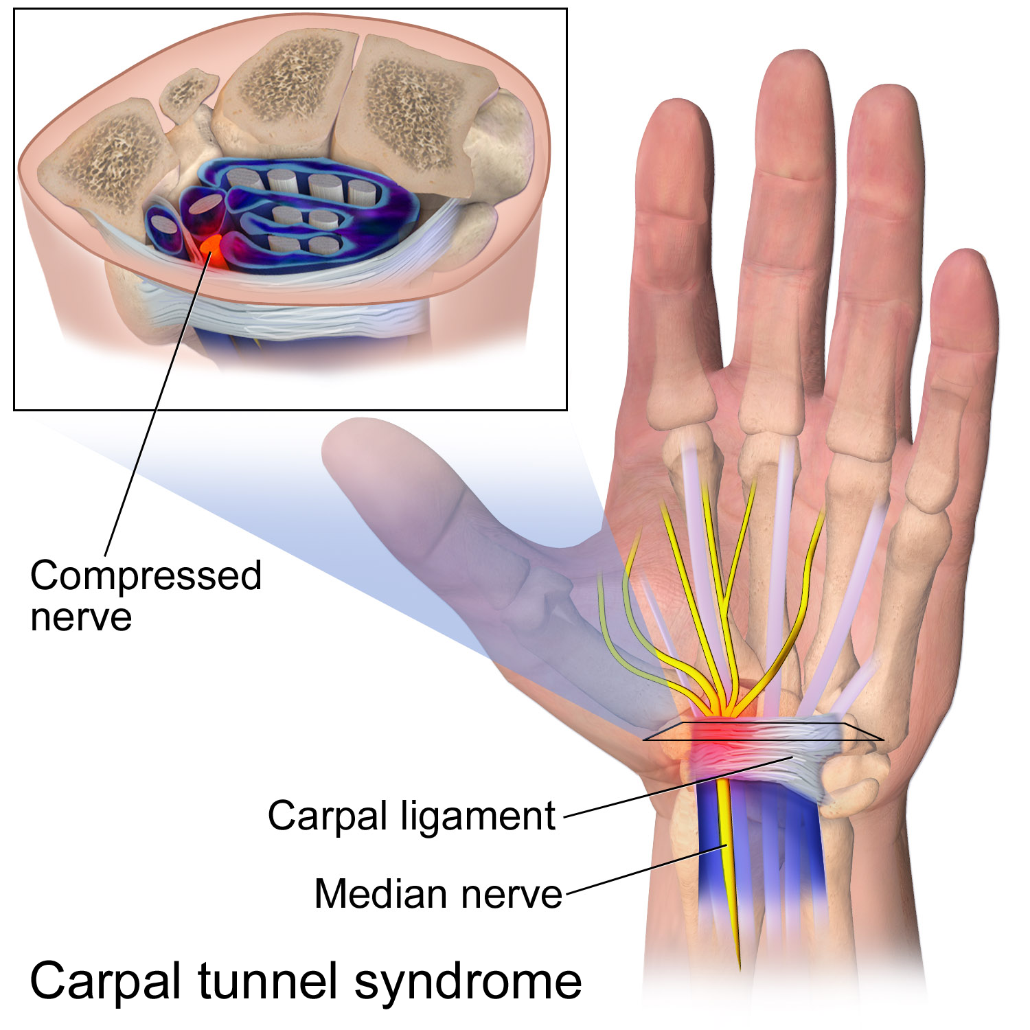 Illustration of carpal tunnel with inflammation shown over the median nerve.