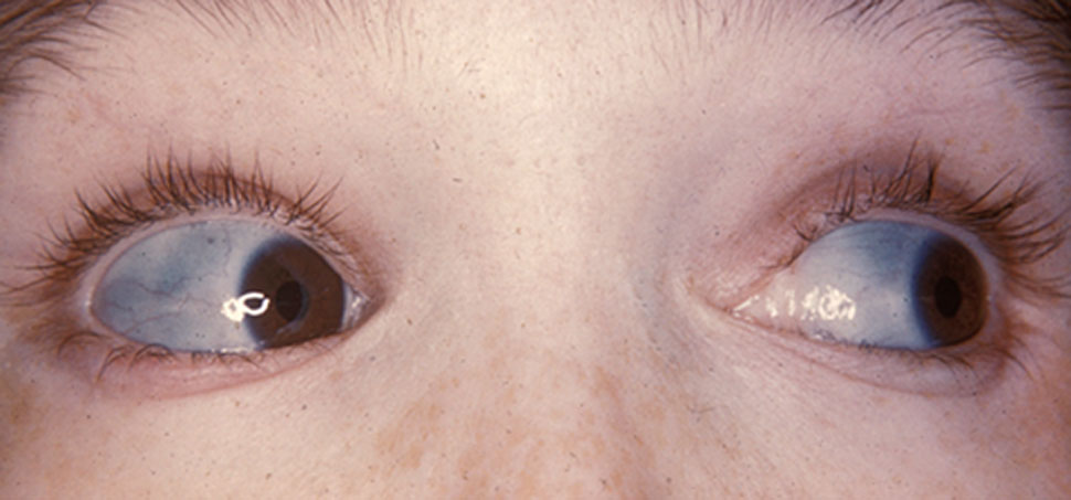 Photo of Blue sclera in Osteogenesis Imperfecta