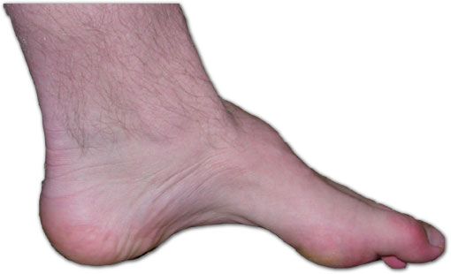 Picture of Charcot foot with high arch and curled toes.