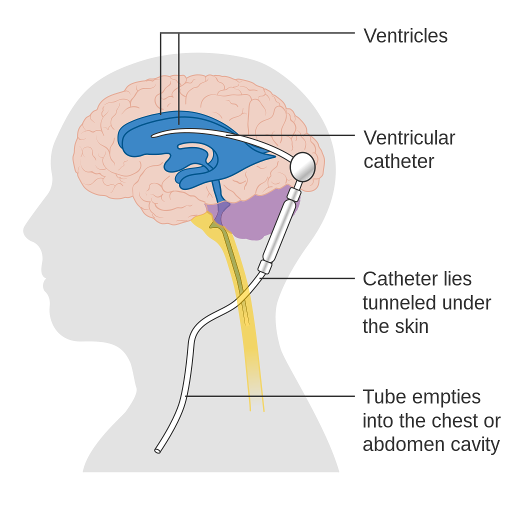Diagram showing a brain shunt CRUK system which allows cerebrospinal fluid to be drained into a different body cavity