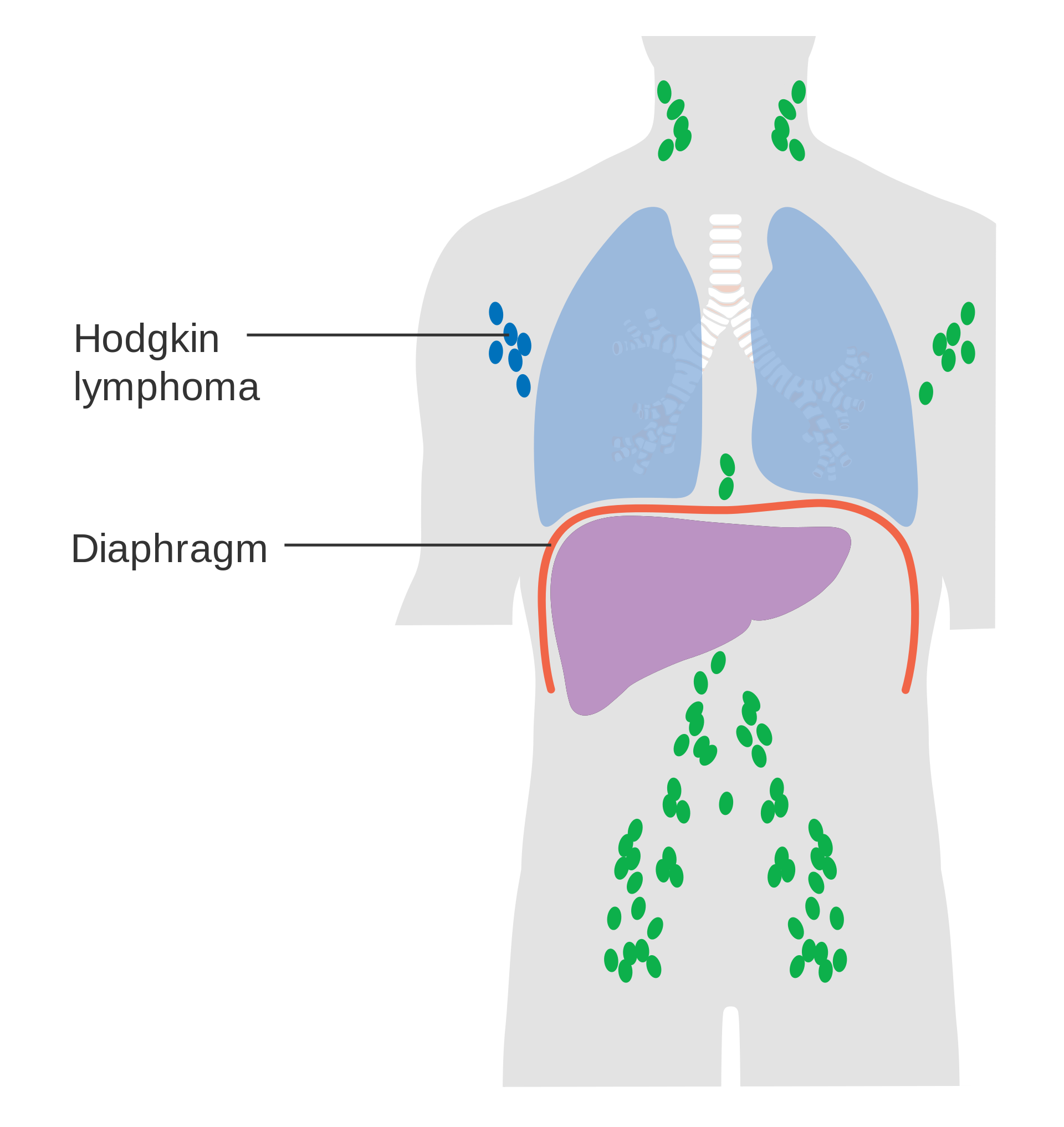 Stage I Hodgkin lymphoma: lymph nodes affected in one area (in this picture the axilla)