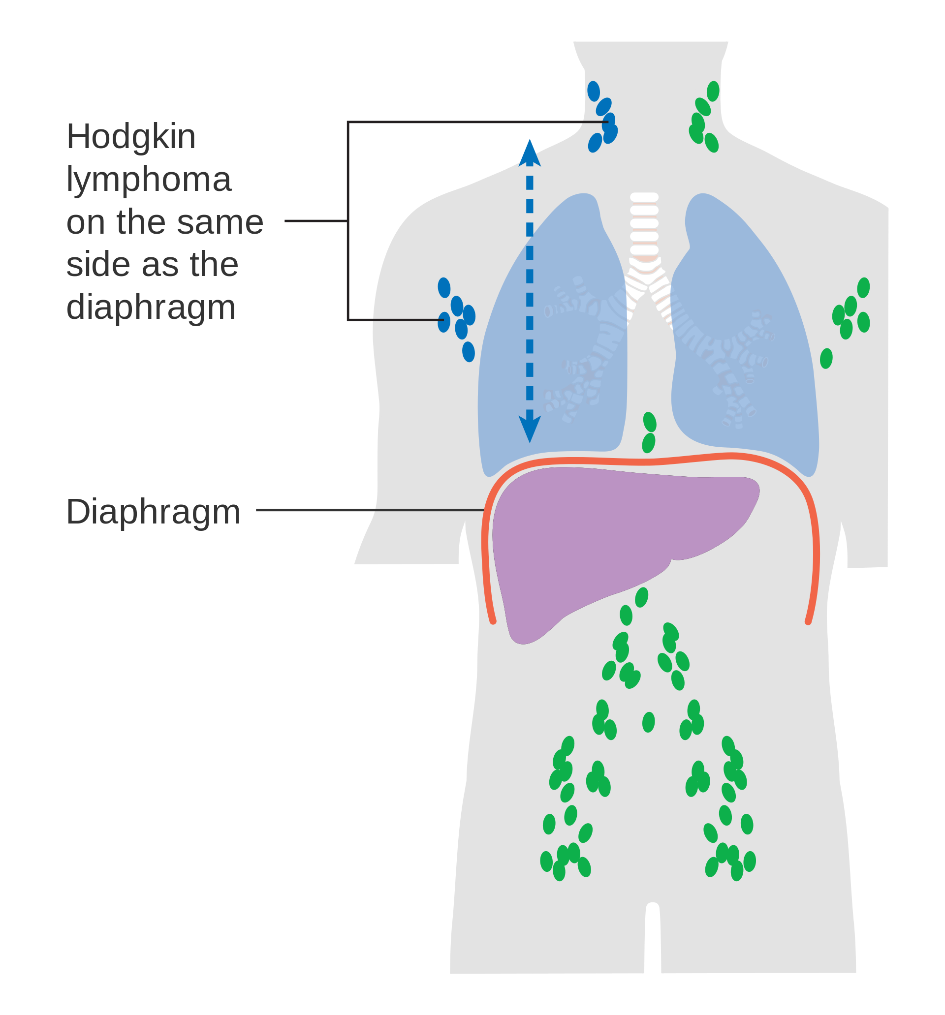 Stage II Hodgkin lymphoma: lymph nodes affected in neck and axilla on the right side above the diaphragm