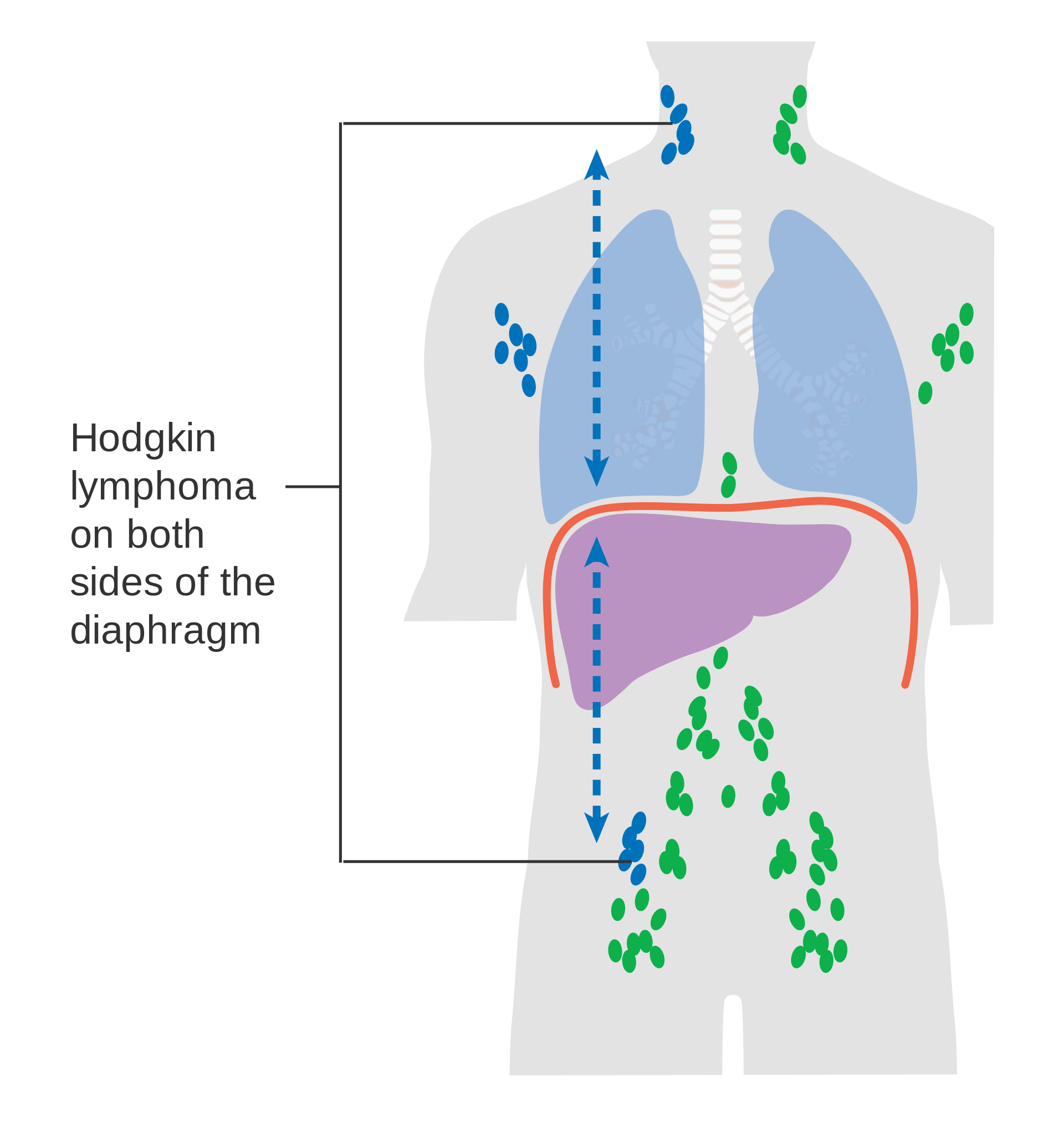 Stage III Hodgkin lymphoma: lymph nodes affected above and below diaphragm