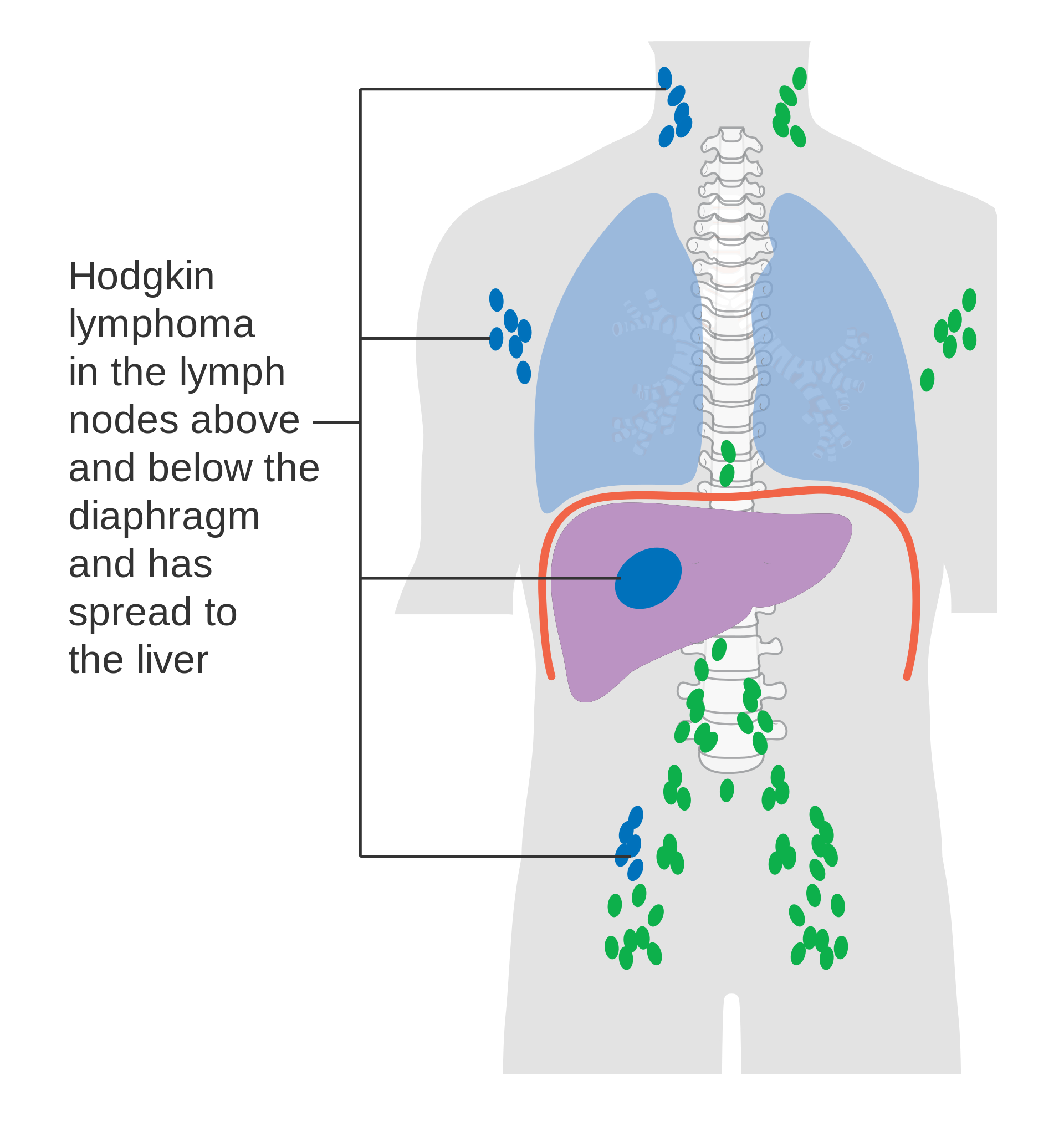 Stage IV Hodgkin lymphoma: lymph nodes above and below the diaphragm are affected and cancer has spread to the liver