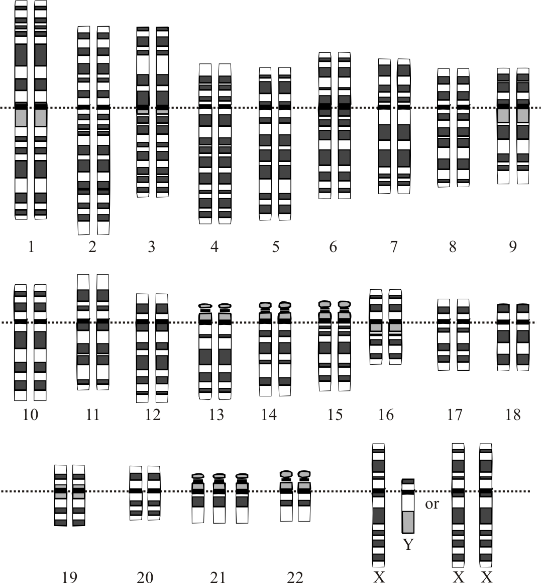 Karyotype of a person with Down Syndrome. Note the 3 chromosomes in the 21st position.