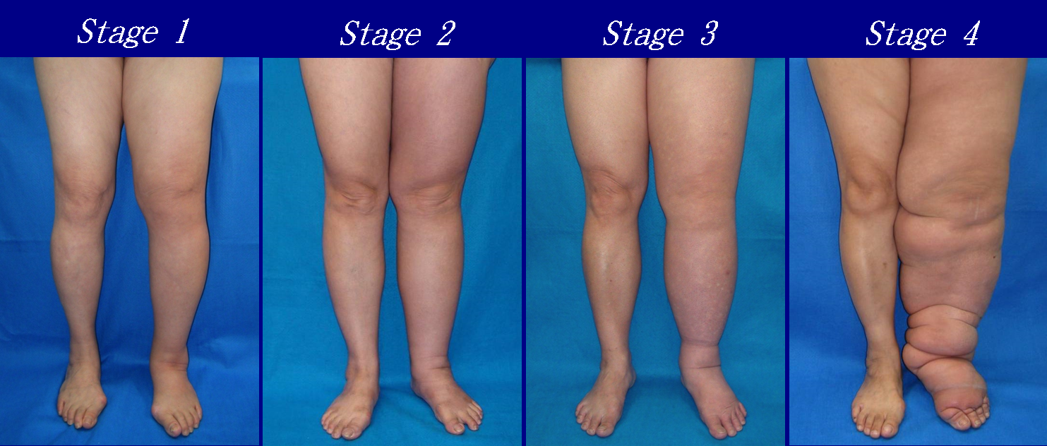 Lymphedema staging in the lower extremity