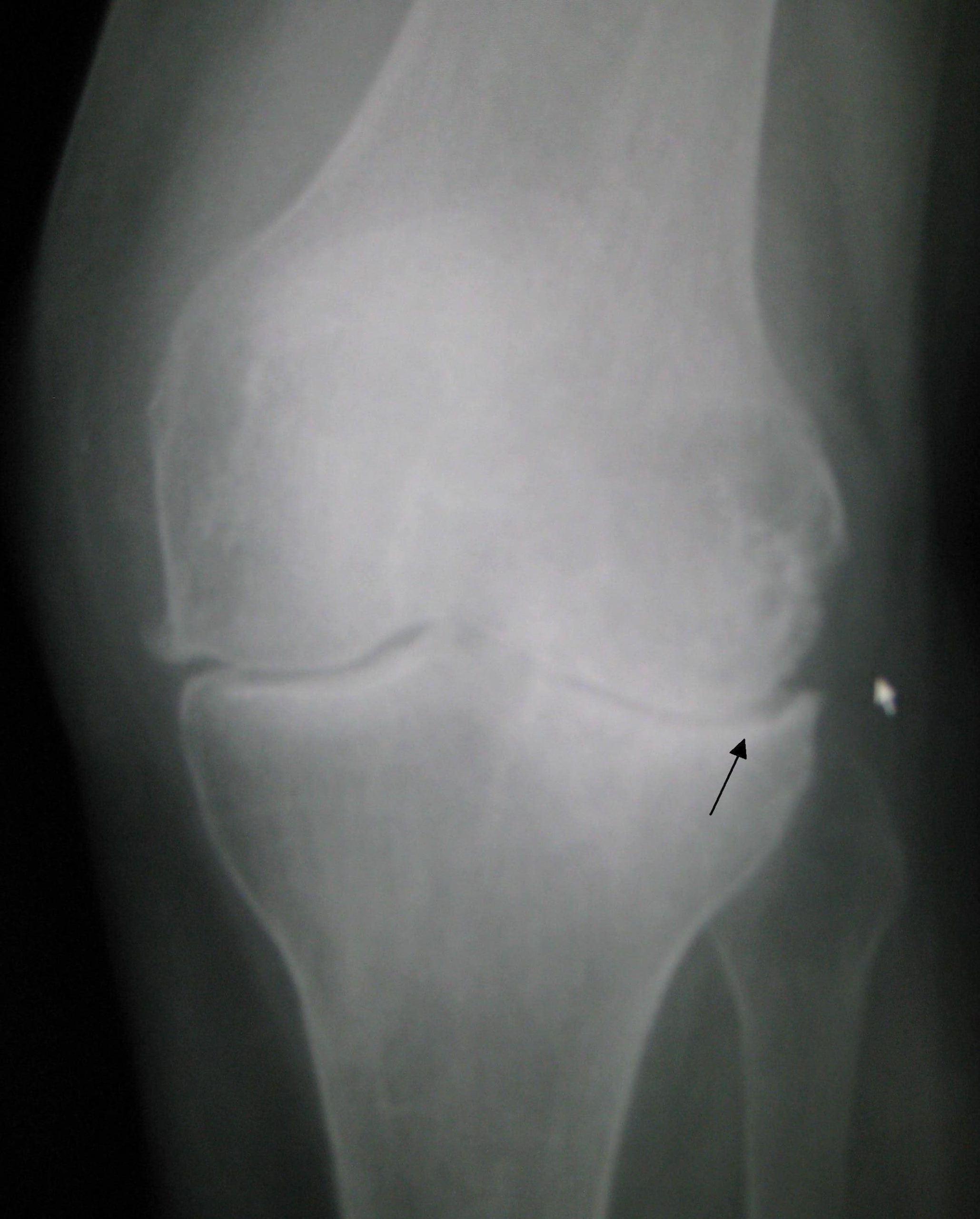 OA in the knee. Note the narrowed joint space.