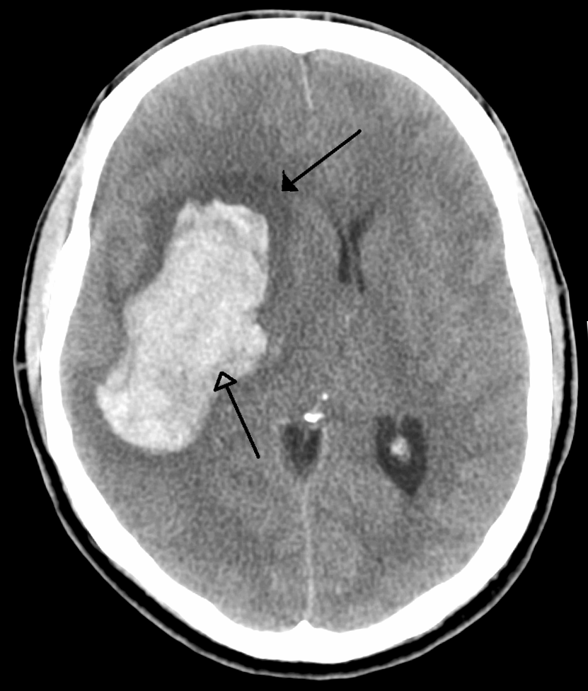 CT scan of an intraparenchymal bleed with surrounding edema