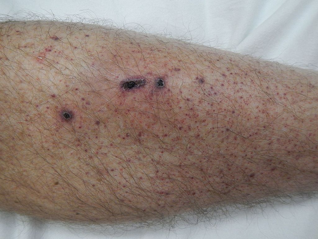 Photo shows petechia of the lower leg. 3 dark sores are shown.