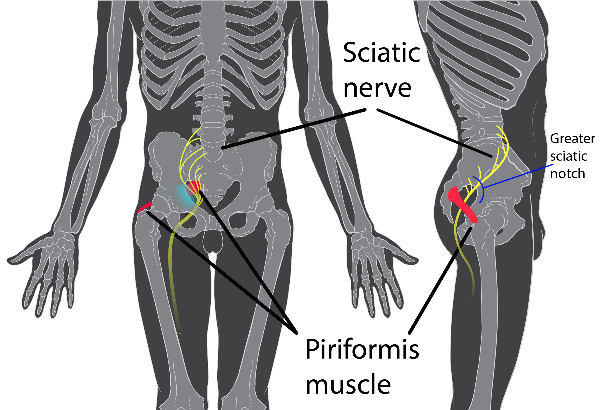an illustration of a persons skeleton with locations of piriformis syndrome highlighted and emphasized in the pelvic area.