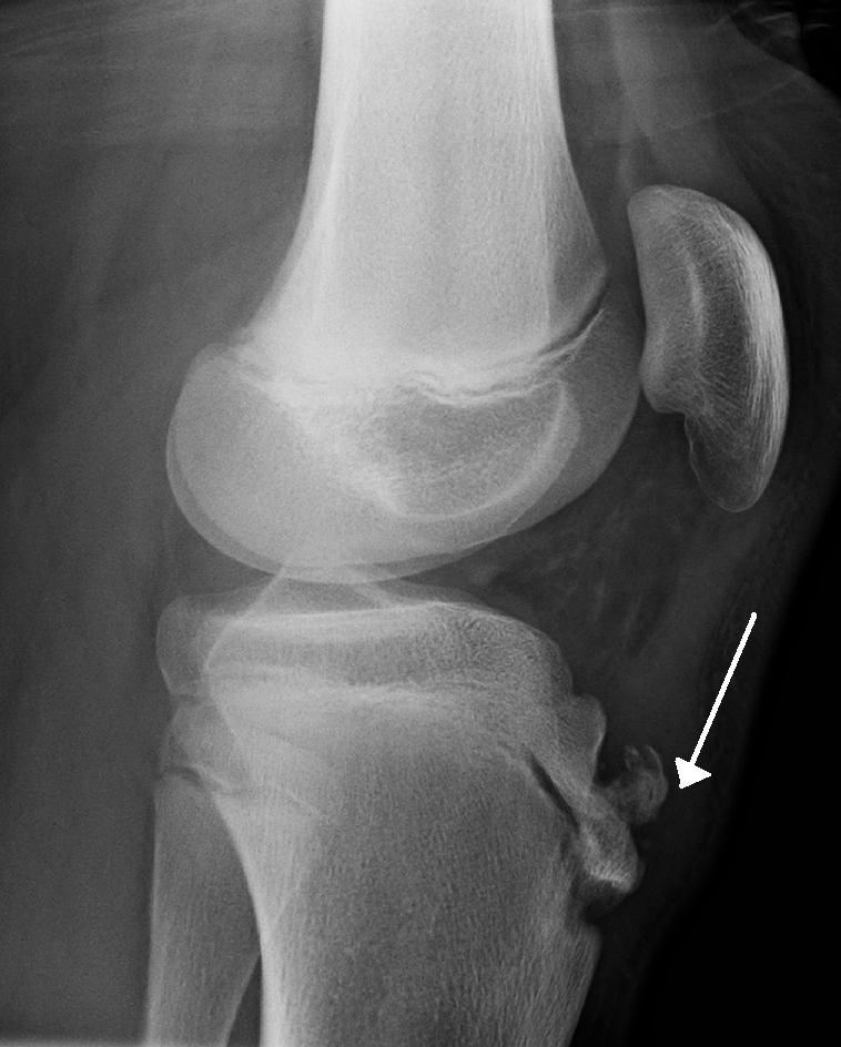 Osgood-Schlatter's disease. Note avulsion fracture of tibial tuberosity