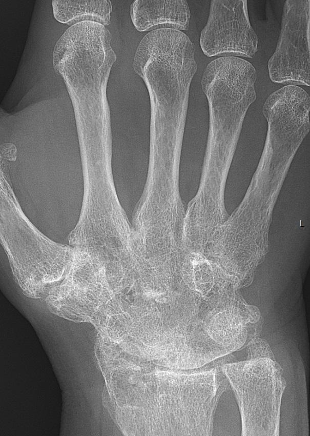 X-ray of RA with ankylosed carpal bones