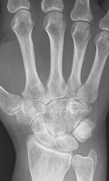 X-ray of RA with unaffected carpal bones