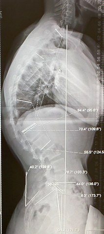 Scheuermann's disease in x-ray