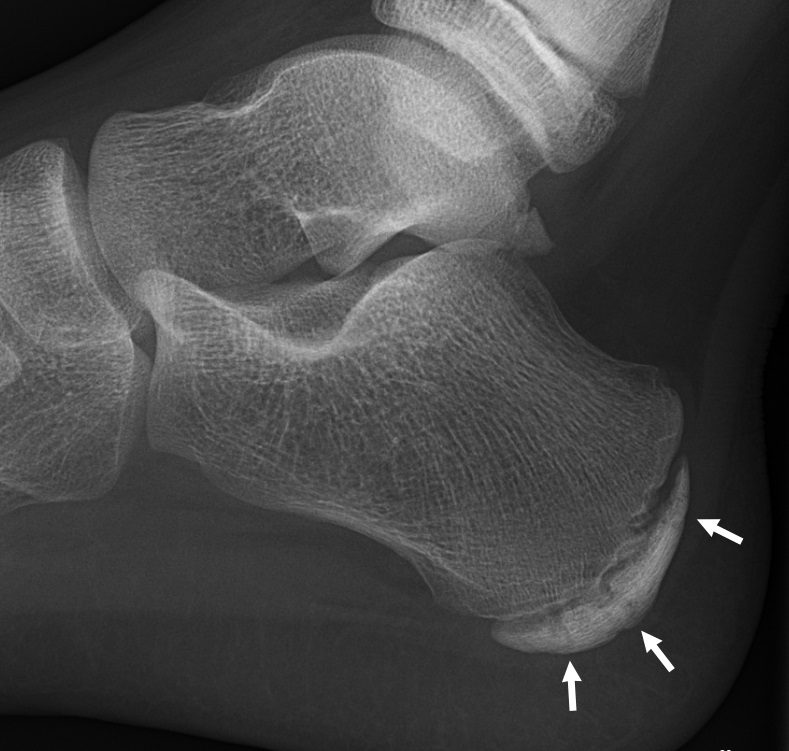 X-ray of Calcaneal apophysitis in Sever's Disease