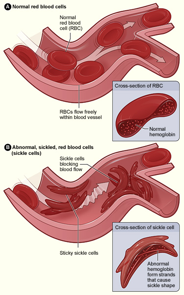 Normal red blood cells flowing freely in a blood vessel. The inset image shows a cross-section of a normal red blood cell with normal hemoglobin. Figure B shows abnormal, sickled red blood cells blocking blood flow in a blood vessel. The inset image shows a cross-section of a sickle cell with abnormal (sickle) hemoglobin forming abnormal strands.