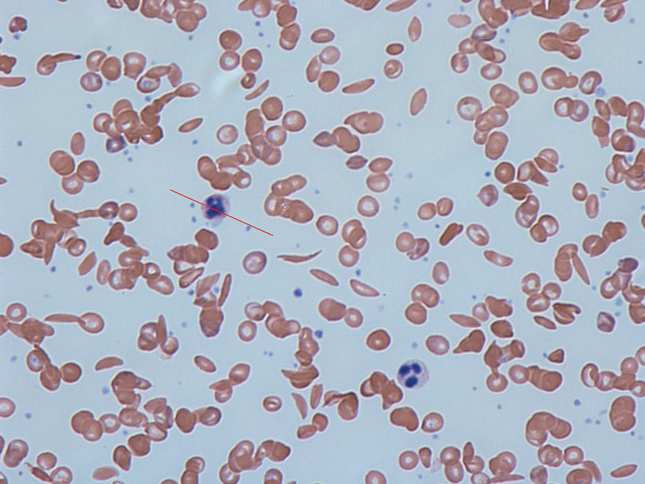 Photo. Sickle-cell disease is a genetic blood disorder characterized by red blood cells that assume an abnormal, rigid, sickle shape