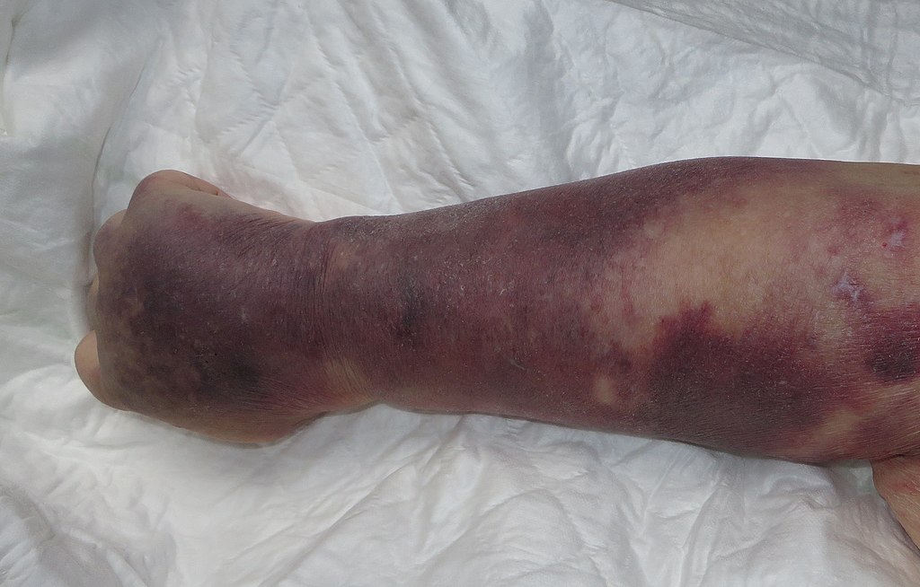 Thrombocitopenia exposure with purpura on right hand in patient with septic shock.