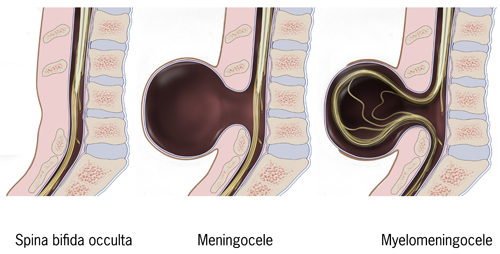 Illustration of 3 types: Spina bifida occulta: not visible. Meningocele: protrusion of the meninges of the spinal cord. Myelomeningocele: protrusion of meninges and nerve tissue.