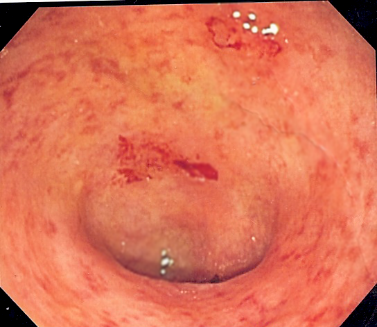 Endoscopic image of ulcerative colitis showing loss of vascular pattern of the sigmoid colon, granularity and some friability of the mucosa.