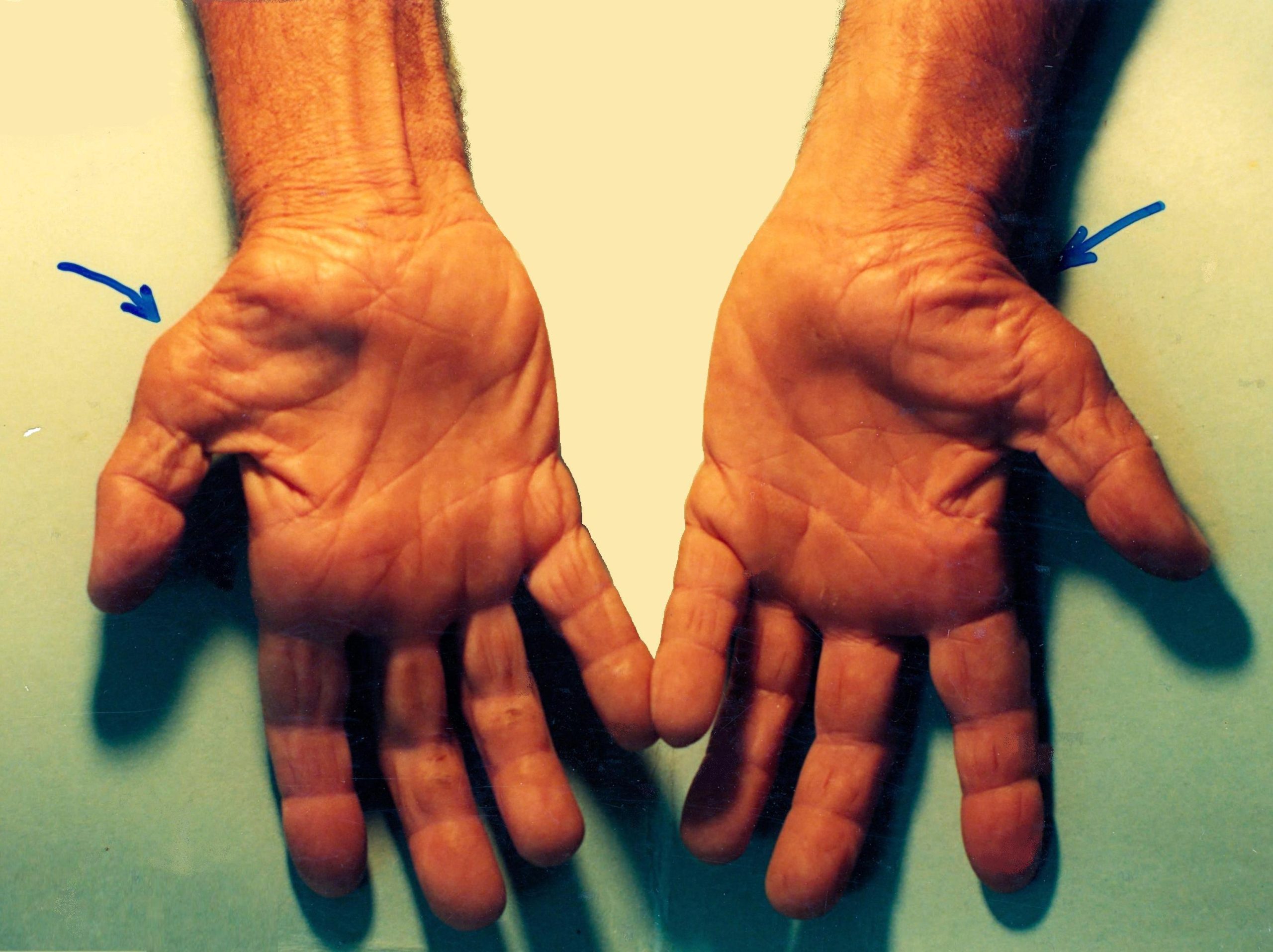 Picture of atrophy of intrinsic thumb musculature