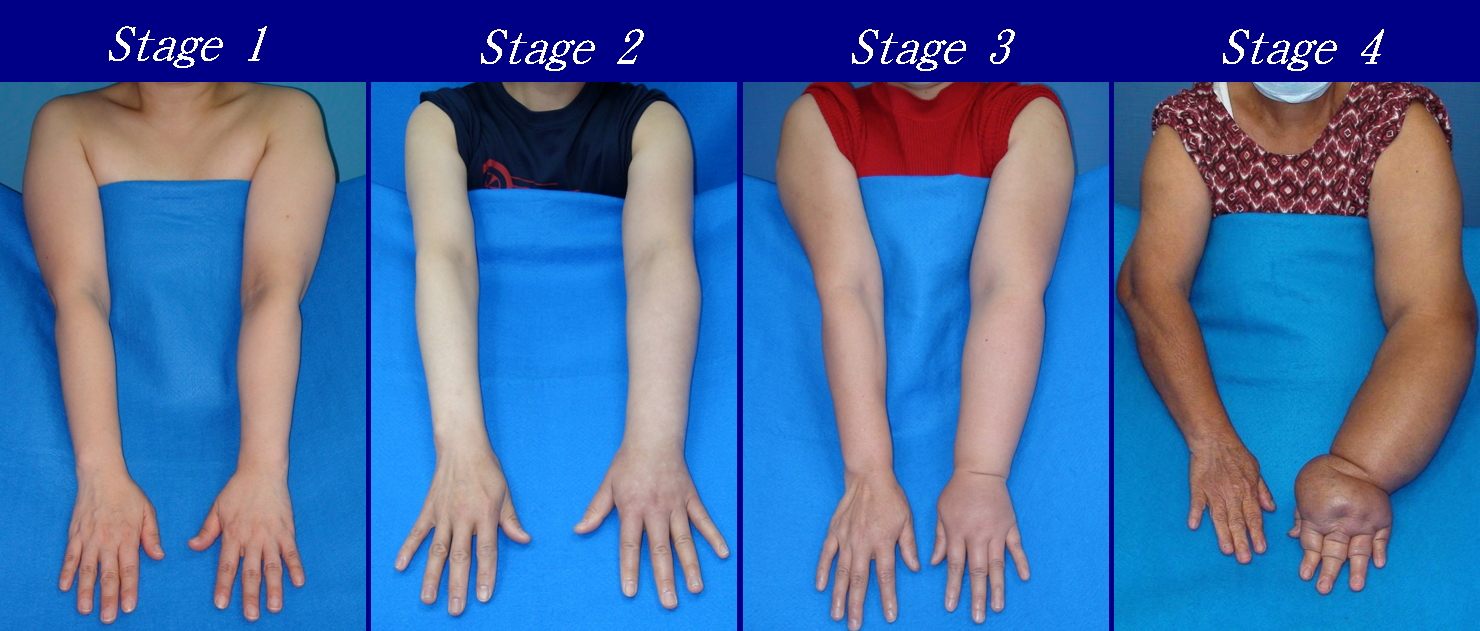 Lymphedema staging in the upper extremity
