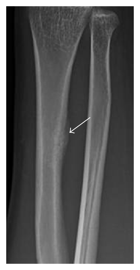 X-ray of Periosteal reaction to stress fracture of the ulna