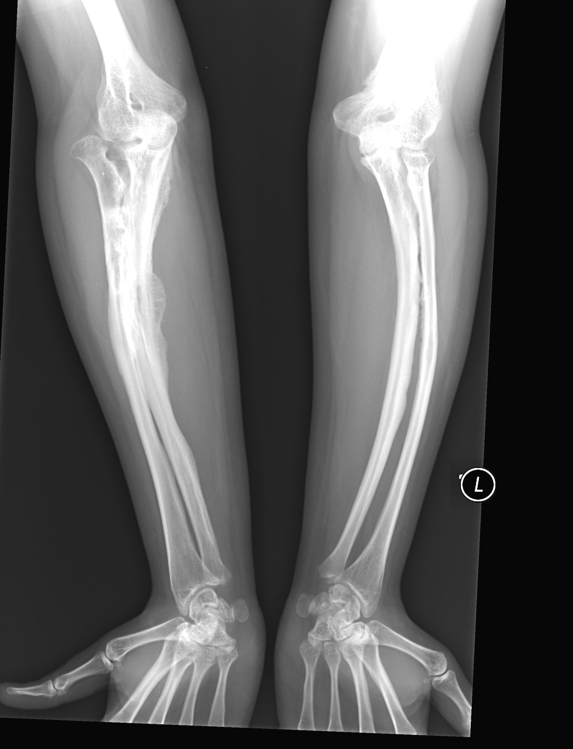 Bowing and fractures seen in osteogenesis imperfecta