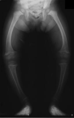 Xray of bowed legs with Rickets