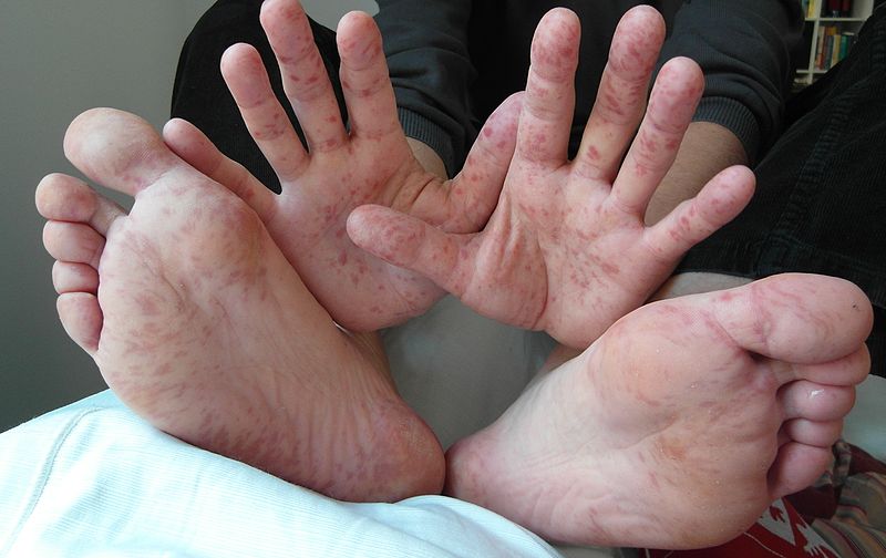 Lesions caused by the Hand, Foot and Mouth Virus on a 36 year old male.