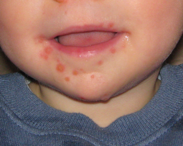 Lesions on the face of a child with Hand, Foot, and Mouth disease.