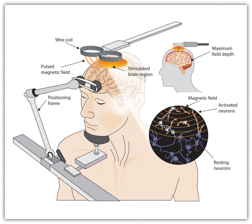 illustration of a patient receiving T.M.S. with wire coils over the top of the head.