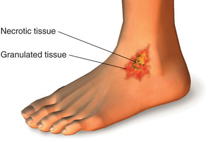 An image of a food that has endured an injury. the image shows the necrotic and granulated tissue of the foot during the healing process.