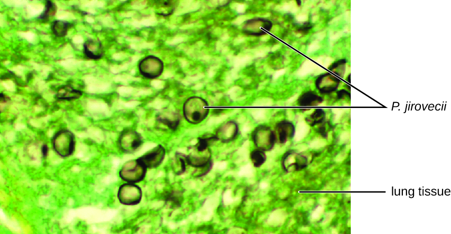 Micrograph showing green stained lung tissue and brown celled labeled P. jiroveci.