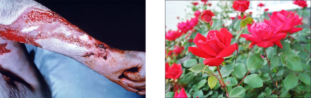 rose gardener's disease