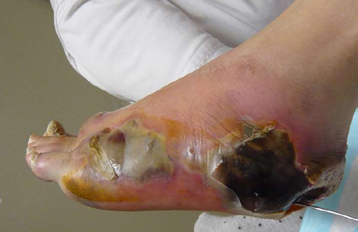 photo: foot with large area of dead skin
