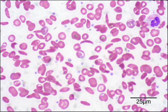 This electron micrograph shows red blood cells from a patient with sickle cell anemia. Most of the cells have a normal, disk shape, but about one in five has a sickle shape. A normal blood cell is eight microns across.