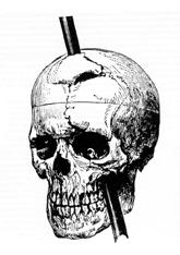 Phineas Gages skull diagram