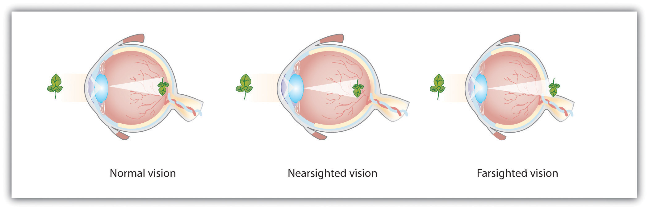 Normal, nearsighted, and farsighted eyes