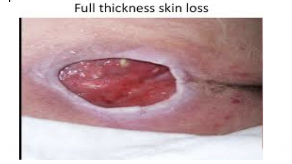 full thickness skin loss