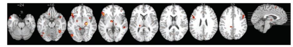 Several x-ray images of a brain from different angles, capturing the different hemispheres, and showing thermal marks on the brain where the emotion anger occurs, and its consistency patterns.