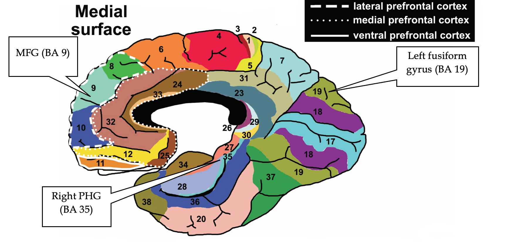 An illustration of a brain from a side view. there are 38 sections numbered and highlighted on this illustration. There are also three different outlines for three different cortexes. The lateral prefrontal cortex is outlined by a dashed white line. The medial prefrontal cortex is outlined by a dotted white line. The ventral prefrontal cortex is outlined by a solid white line. 3 of the 38 sections are emphasized in the image, they are: MFG (BA 9), Right PHG (BA 35), and Left fusiform gyrus (BA 19).