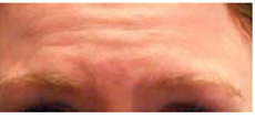 An image example of Action Unit 1: Inner brow raiser.