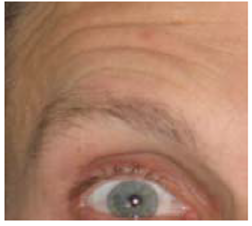 An image example of the action unit 2: Outer brow raiser.